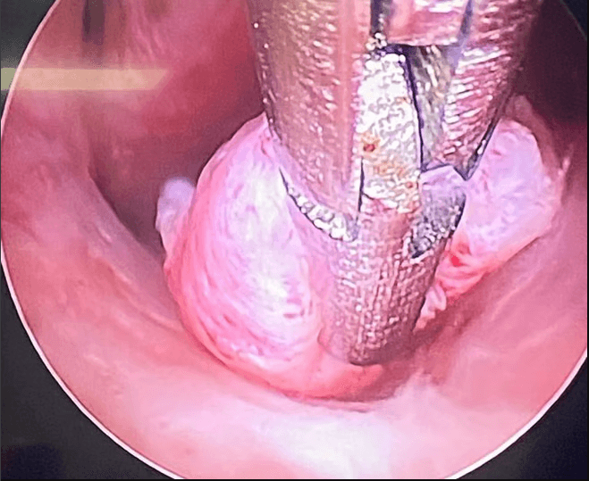 Imagem de Histeroscopia Cirúrgica - Procedimento minimamente invasivo