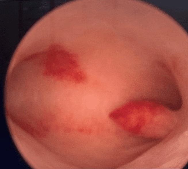 Imagem de Histeroscopia Diagnóstica - Visualização do endométrio